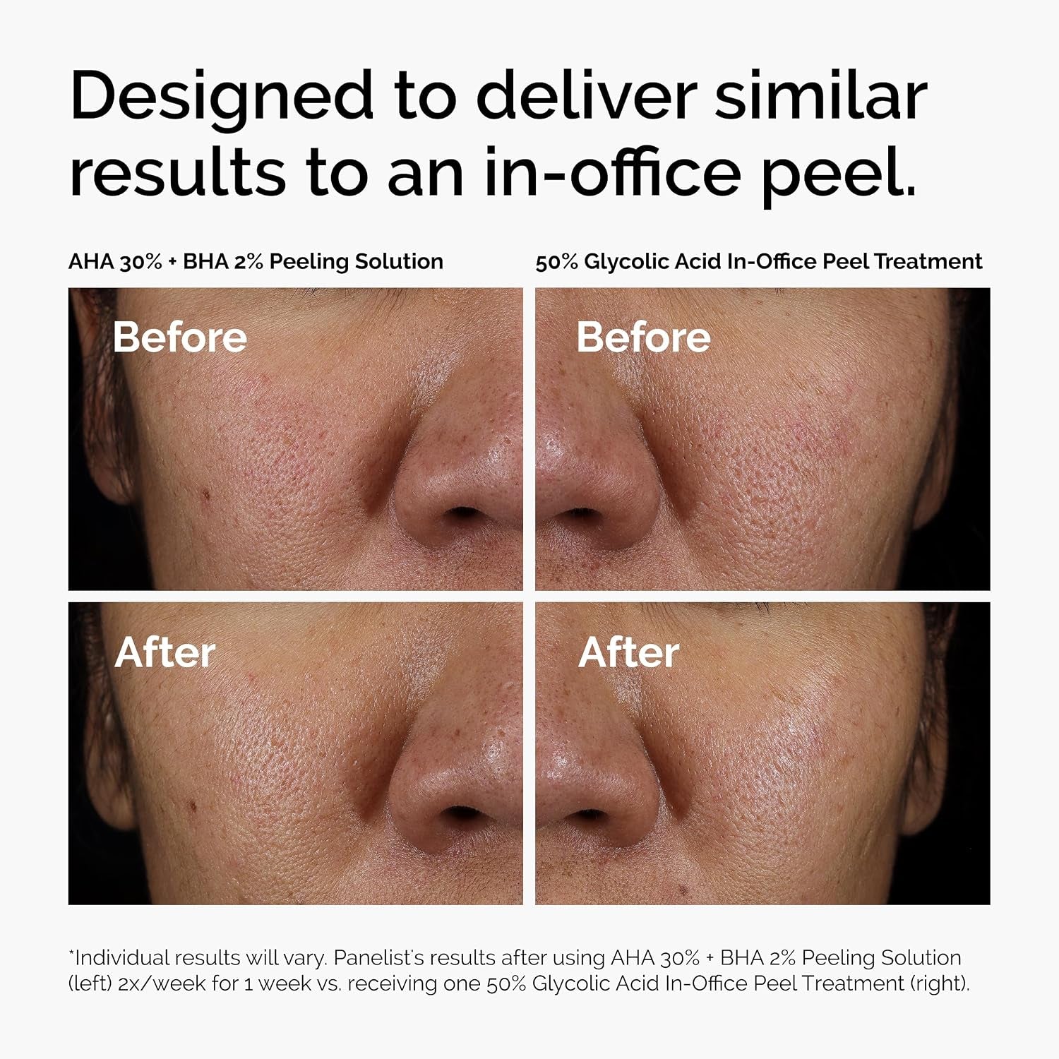 The Ordinary AHA 30% + BHA 2% Peeling Solution, Advanced Exfoliating Peel for Brighter Skin, 30Ml