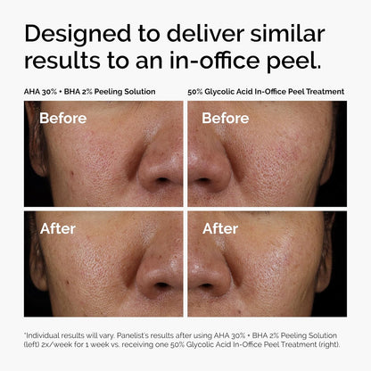 The Ordinary AHA 30% + BHA 2% Peeling Solution, Advanced Exfoliating Peel for Brighter Skin, 30Ml